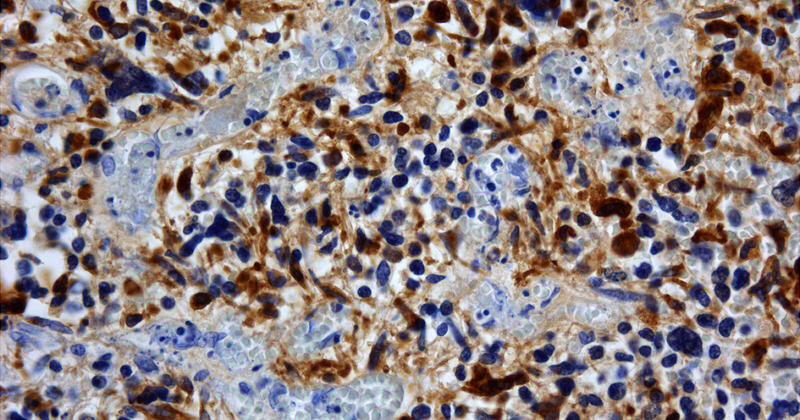 膠質母細胞瘤, glioblastoma (圖片來源: wikimedia)