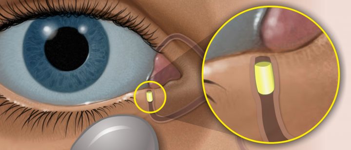 Ocular青光眼插入藥物 三期試驗未達試驗終點。(圖片來源:Ocular Therapeutix)
