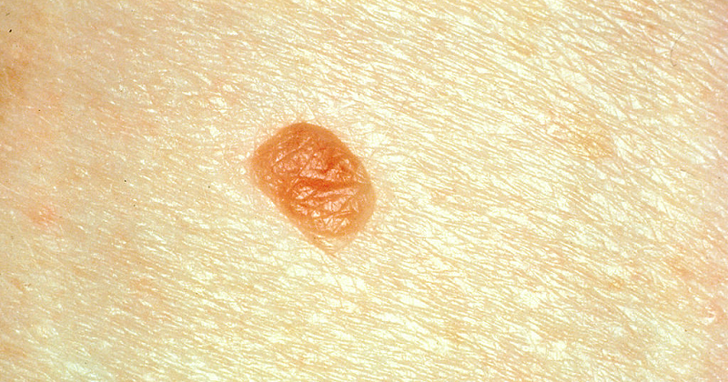 Skin Analytics開發AI診斷黑色素瘤,助減輕英國醫療系統負擔。此圖為普通的痣。(圖源:網路)