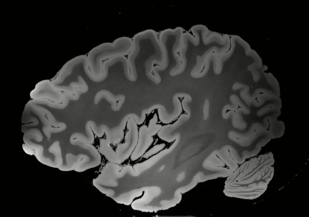 《Science》唐氏症有解?科學家成功逆轉小鼠認知受損。(圖片來源:網路)