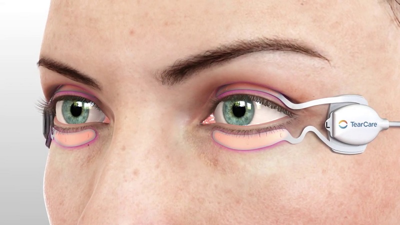 (圖片來源:Sight Sciences)